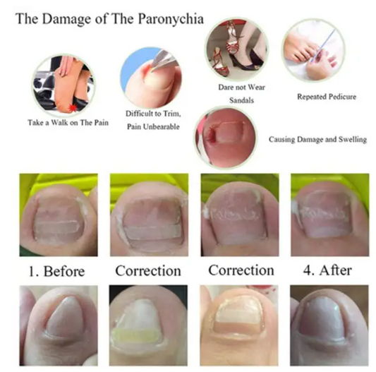 Parche Correctivo Ortodóntico para Uñas Encarnadas con Pinzas de Manicura - Image 2