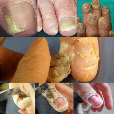 Removedor de Cutículas y Callos - Herramienta Profesional para Pedicura - Image 7