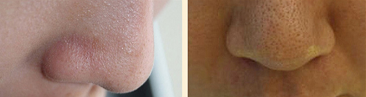 Mascarilla Limpiadora Profunda Antiespinillas - Image 9