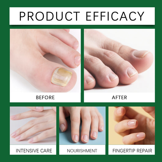 Solución de Cuidado de Uñas con Jengibre - Image 10