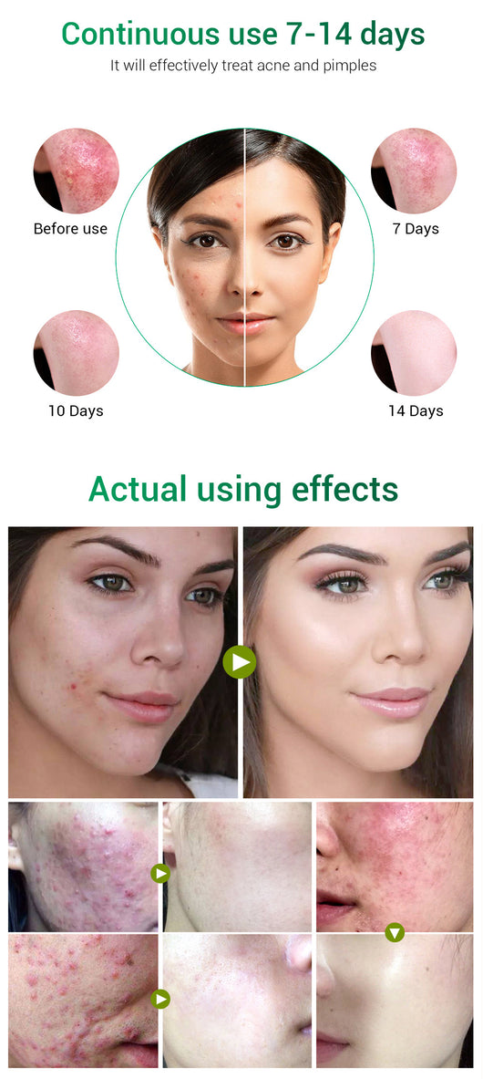 Crema Facial de Árbol de Té BREYLEE - Tratamiento Anti-Acné y Cicatrices - Image 15