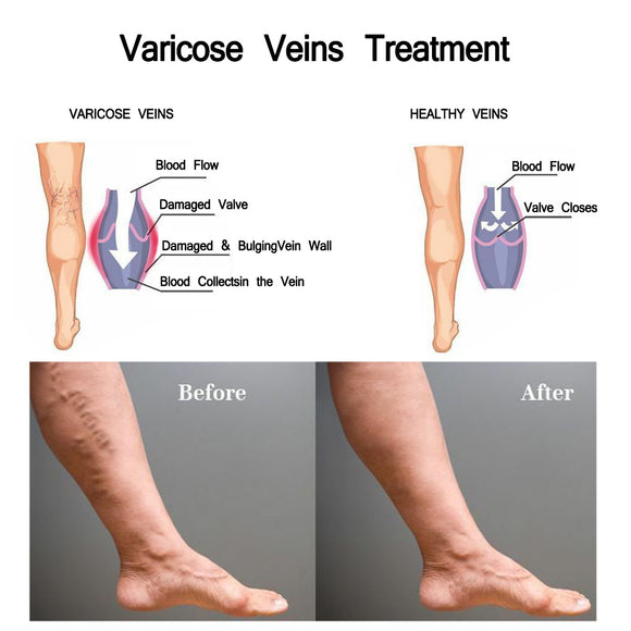 Crema para Varices y Circulación