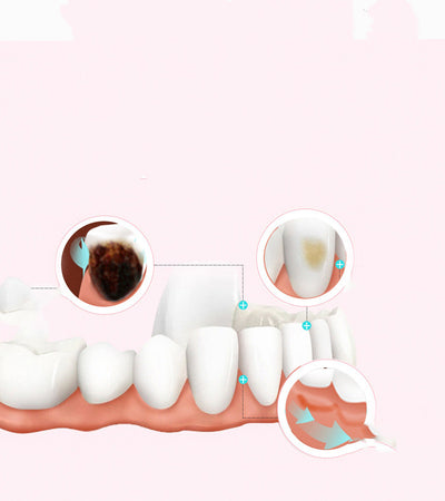 Limpiador Ultrasónico Dental Profesional con Tecnología de Blanqueamiento - Image 5