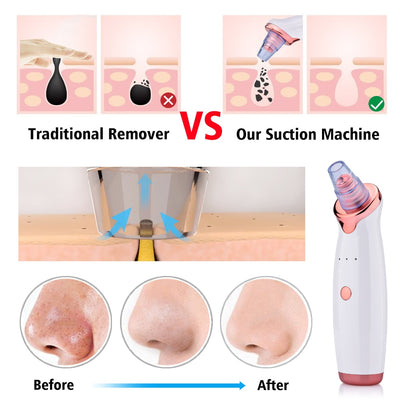 Extractor de Puntos Negros Eléctrico con Succión Facial - Image 9