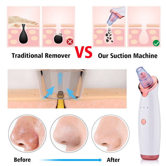 Extractor de Puntos Negros Eléctrico con Succión Facial - Image 9