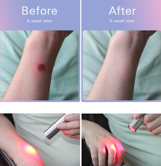 Lámpara de Fototerapia Infrarroja Portátil - Luz Roja Terapéutica - Image 3