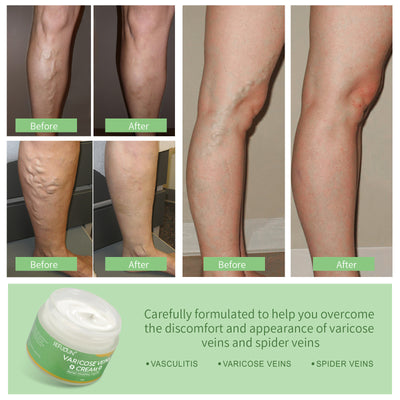 Crema Reparadora para Varices y Hematomas - Alivio de Dolor con Cártamo - Image 11