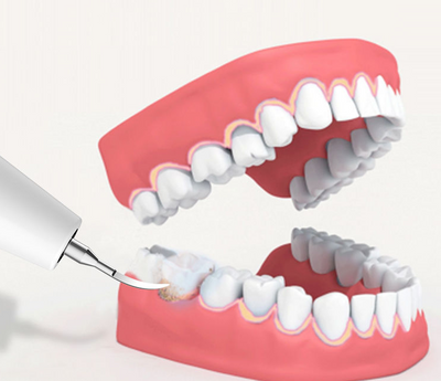 Removedor Ultrasónico de Sarro Dental Eléctrico Profesional - Image 14