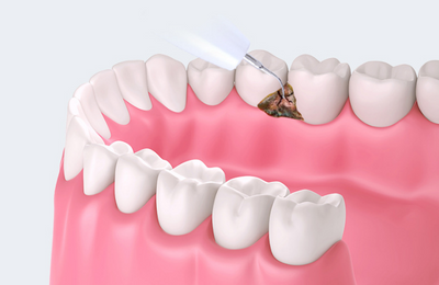 Limpiador Ultrasónico Dental Profesional para Blanqueamiento de Dientes - Image 12