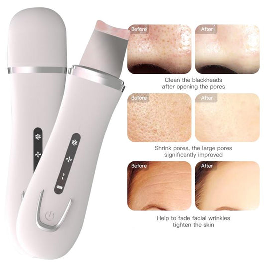 Limpiador Eléctrico de Poros Facial - Image 11