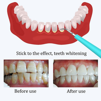 Removedor de Sarro Dental Profesional - Image 13