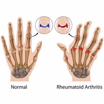 Guantes de Compresión con Cobre para Terapia - Image 13