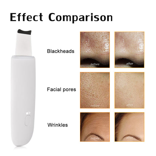 Limpiador Ultrasónico de Poros con Tecnología de Espátula - Image 10