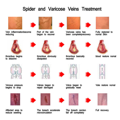 Crema para Varices y Circulación - Image 9