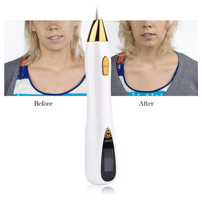 Bolígrafo Removedor de Lunares - Equipo de Belleza Profesional - Image 18