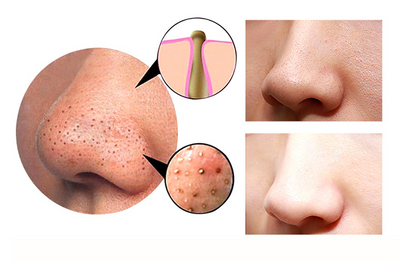 Dispositivo 4 en 1 de Limpieza Facial: Gua Sha, Succión, Extractor de Puntos Negros y Poros Profundos - Image 6