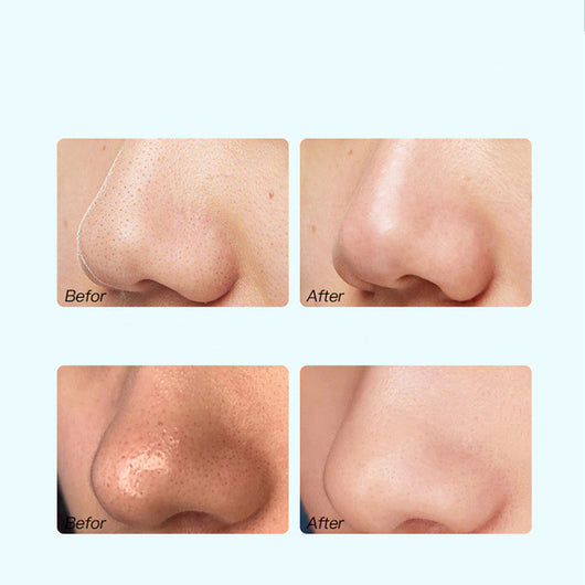 Limpiador Profundo Facial - Eliminador de Puntos Negros y Acné - Image 11