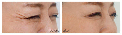 Dispositivo de Rejuvenecimiento Facial con Tecnología Fotón para Acné - Image 14
