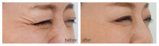 Dispositivo de Rejuvenecimiento Facial con Tecnología Fotón para Acné - Image 14