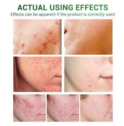Sérum Reparador Anti-Acné con Aceite Facial - Image 7