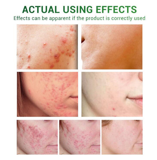 Sérum Reparador Anti-Acné con Aceite Facial - Image 7