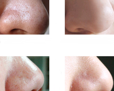 Mascarilla Nasal de Carbón de Bambú - Kit Completo Limpiador de Poros y Eliminador de Espinillas - Image 3