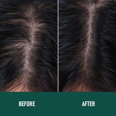 Mousse Anticaída Minoxidil CH004 - Image 18
