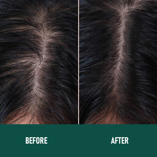 Mousse Anticaída Minoxidil CH004 - Image 18