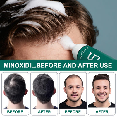 Mousse Anticaída Minoxidil CH004 - Image 19