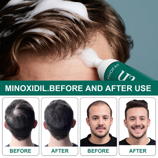 Mousse Anticaída Minoxidil CH004 - Image 19