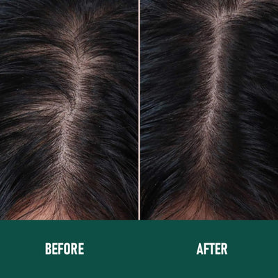 Mousse Anticaída Minoxidil CH004 - Image 8