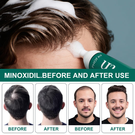 Mousse Anticaída Minoxidil CH004 - Image 9