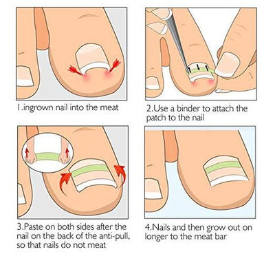 Parche Correctivo Ortodóntico para Uñas Encarnadas con Pinzas de Manicura - Image 4