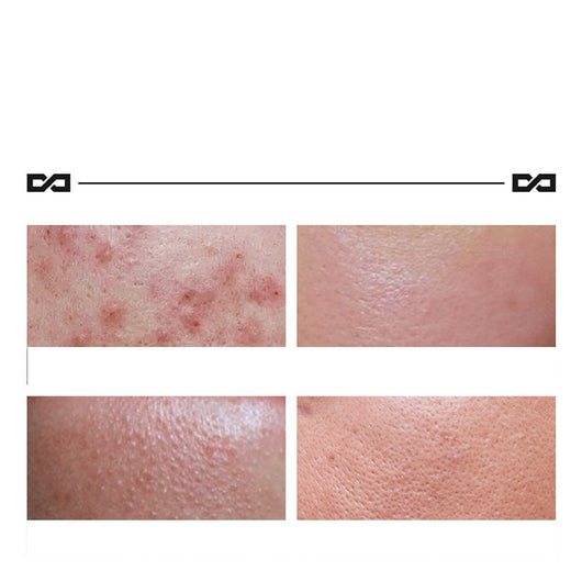 Crema Herbácea Aclarant para Acné y Manchas - Image 6