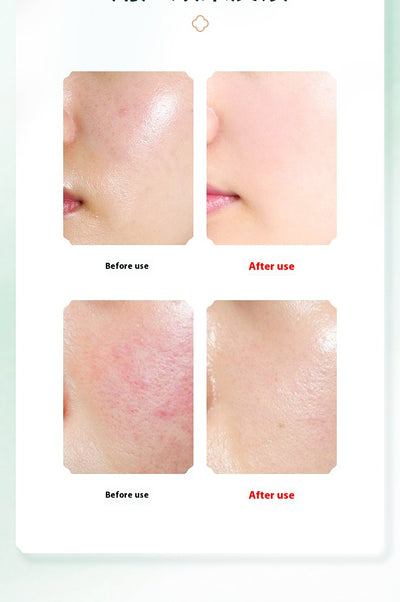 Limpiador Facial Poro Eléctrico Efecto Calor - Image 24