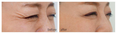 Dispositivo de Rejuvenecimiento Facial con Tecnología Fotón para Acné - Image 4