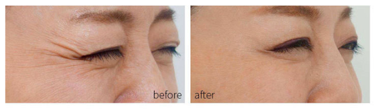 Dispositivo de Rejuvenecimiento Facial con Tecnología Fotón para Acné - Image 4