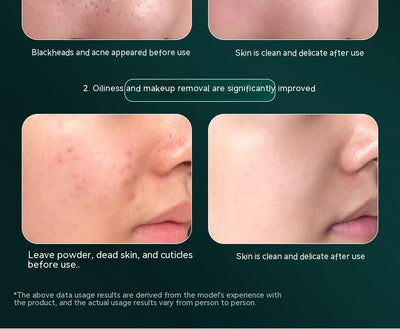 Limpiador Ultrasónico Facial con Masaje Lifting y Tonificación - Image 10