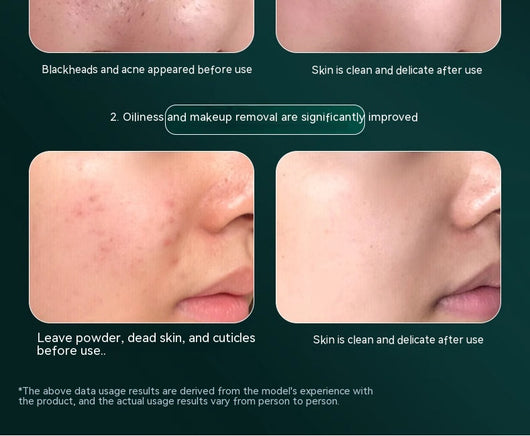 Limpiador Ultrasónico Facial con Masaje Lifting y Tonificación - Image 10