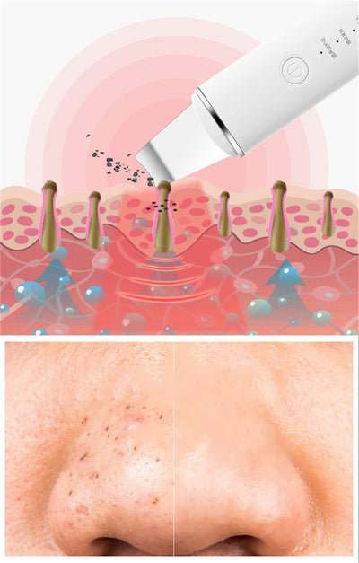 Limpiador Facial Ultrasónico Eliminador de Puntos Negros - Image 35