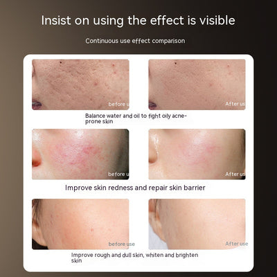 Máscara LED IPL Fotodinámica para Tratamiento Facial en Casa - Image 11