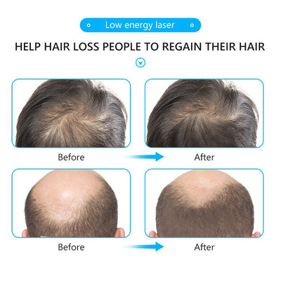 Casco Láser Regenerador de Cabello - Image 6
