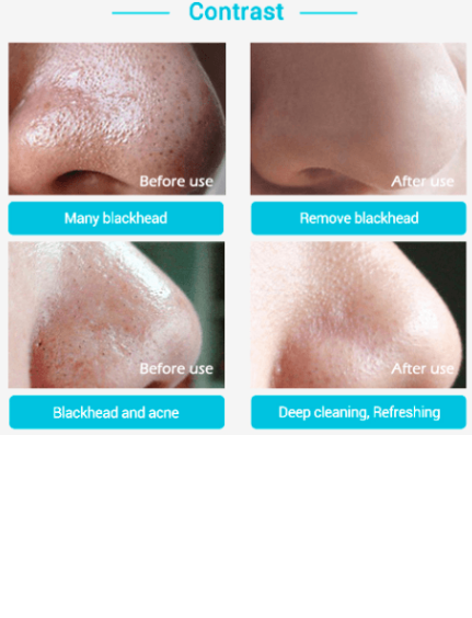 Mascarilla Nasal Limpiadora de Puntos Negros - 60 Láminas Potentes para Zona T - Image 2