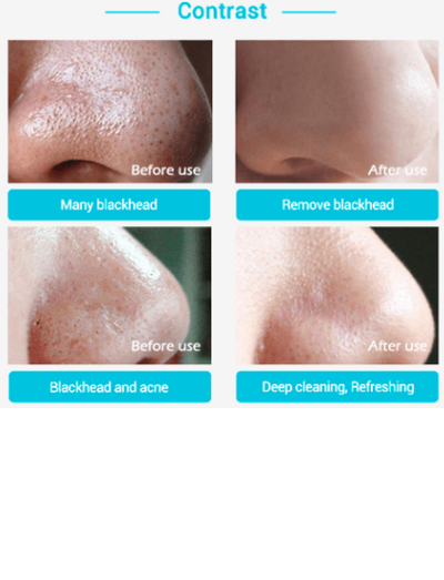 Mascarilla Nasal Limpiadora de Puntos Negros - 60 Láminas Potentes para Zona T - Image 2