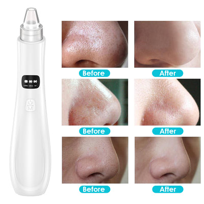 Limpiador Facial Eléctrico de Poros - Extractor de Puntos Negros y Acné - Image 17