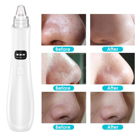 Limpiador Facial Eléctrico de Poros - Extractor de Puntos Negros y Acné - Image 17