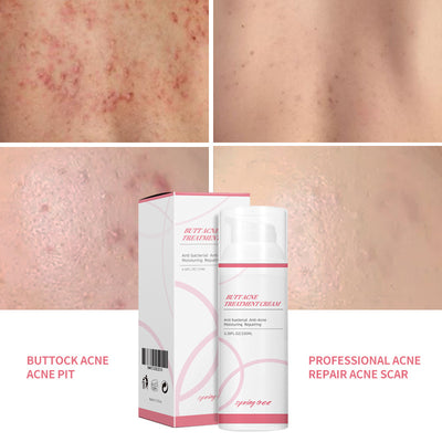 Crema Especializada para Acné en Glúteos - Tratamiento Dermatológico - Image 6