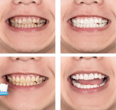 Agente Blanqueador Dental con Luz Azul LANBENA - Image 3