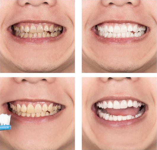 Agente Blanqueador Dental con Luz Azul LANBENA - Image 3