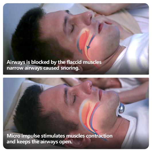 Dispositivo Inteligente Anti Ronquidos con Estimulación Muscular Electrónica - Image 4